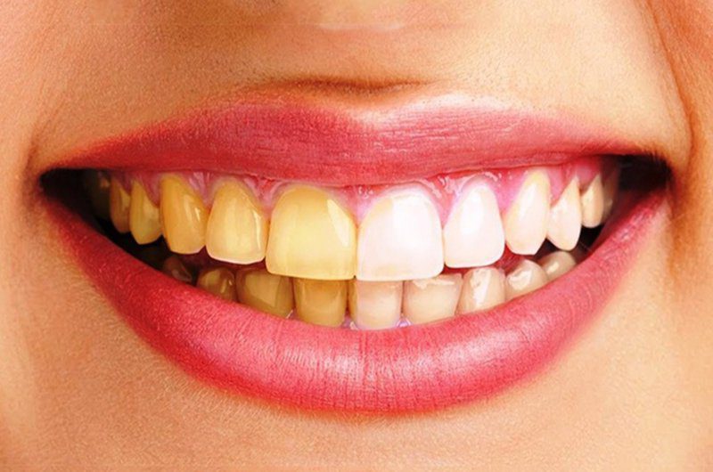 اشتباهات رایج هنگام مسواک زدن/علت زردی دندان 1 https://asreeno.ir/wp-content/uploads/2024/09/زردیدندان.jpg اشتباهات رایج هنگام مسواک زدن/علت زردی دندان