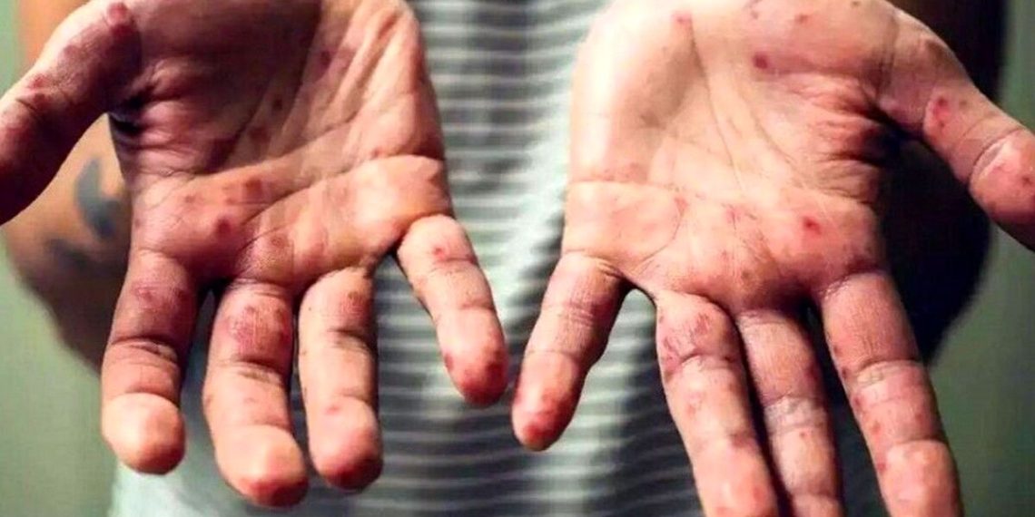 متخصصان نسبت به افزایش شیوع آبله میمون در بین انسان‌ها هشدار دادند