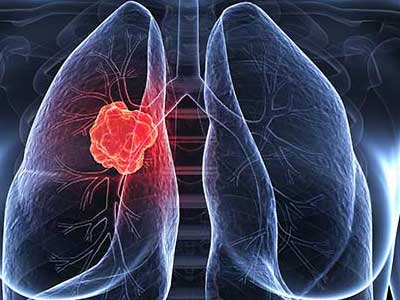 دلایل ابتلا به سرطان ریه در افراد غیرسیگاری 1 https://asreeno.ir/wp-content/uploads/2025/07/Lung-cancer-0022.jpg دلایل ابتلا به سرطان ریه در افراد غیرسیگاری
