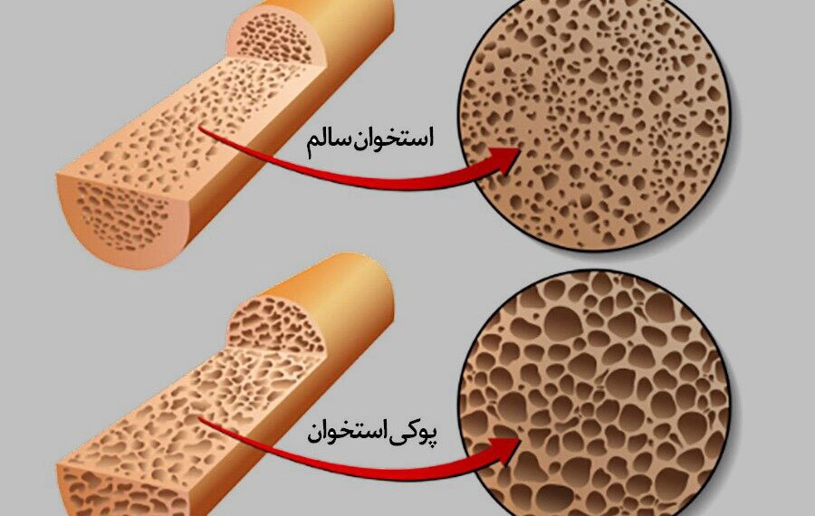پوکی استخوان از دهه چهارم زندگی شروع می‌شود