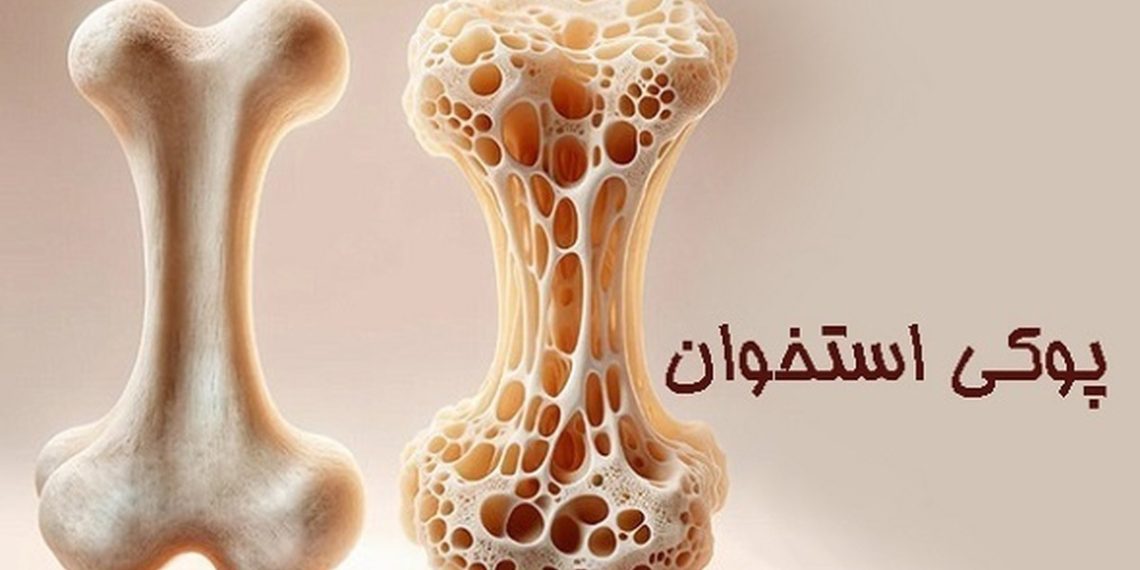 پوکی استخوان از کودکی شروع می‌شود؛ پیشگیری از جنینی تا بلوغ کلید سلامت استخوان در پیری